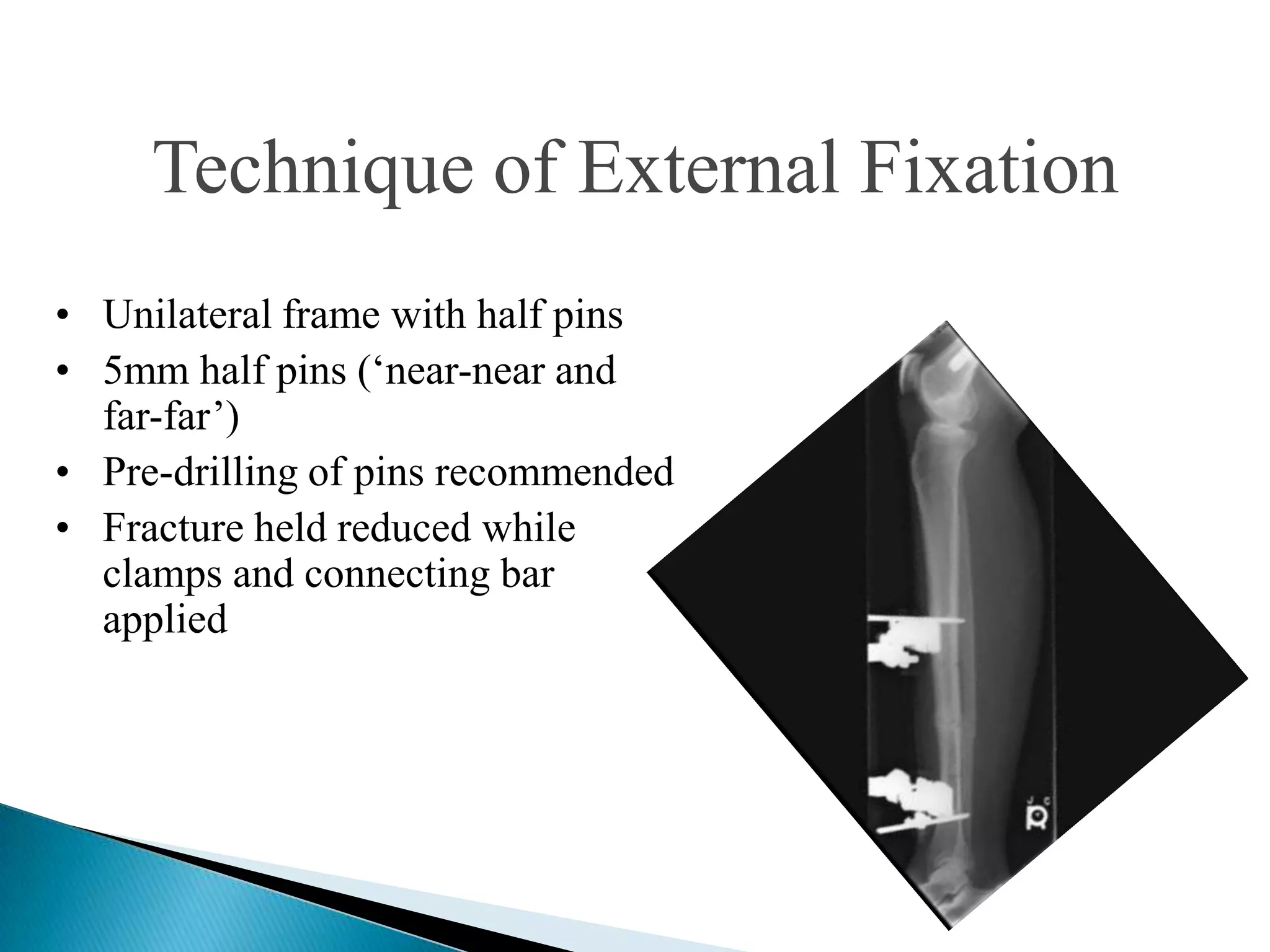 Technique of External Fixation
• Unilateral frame with half pins
• 5mm half pins („near-near and
far-far‟)
• Pre-drilling of pins recommended
• Fracture held reduced while
clamps and connecting bar
applied

 