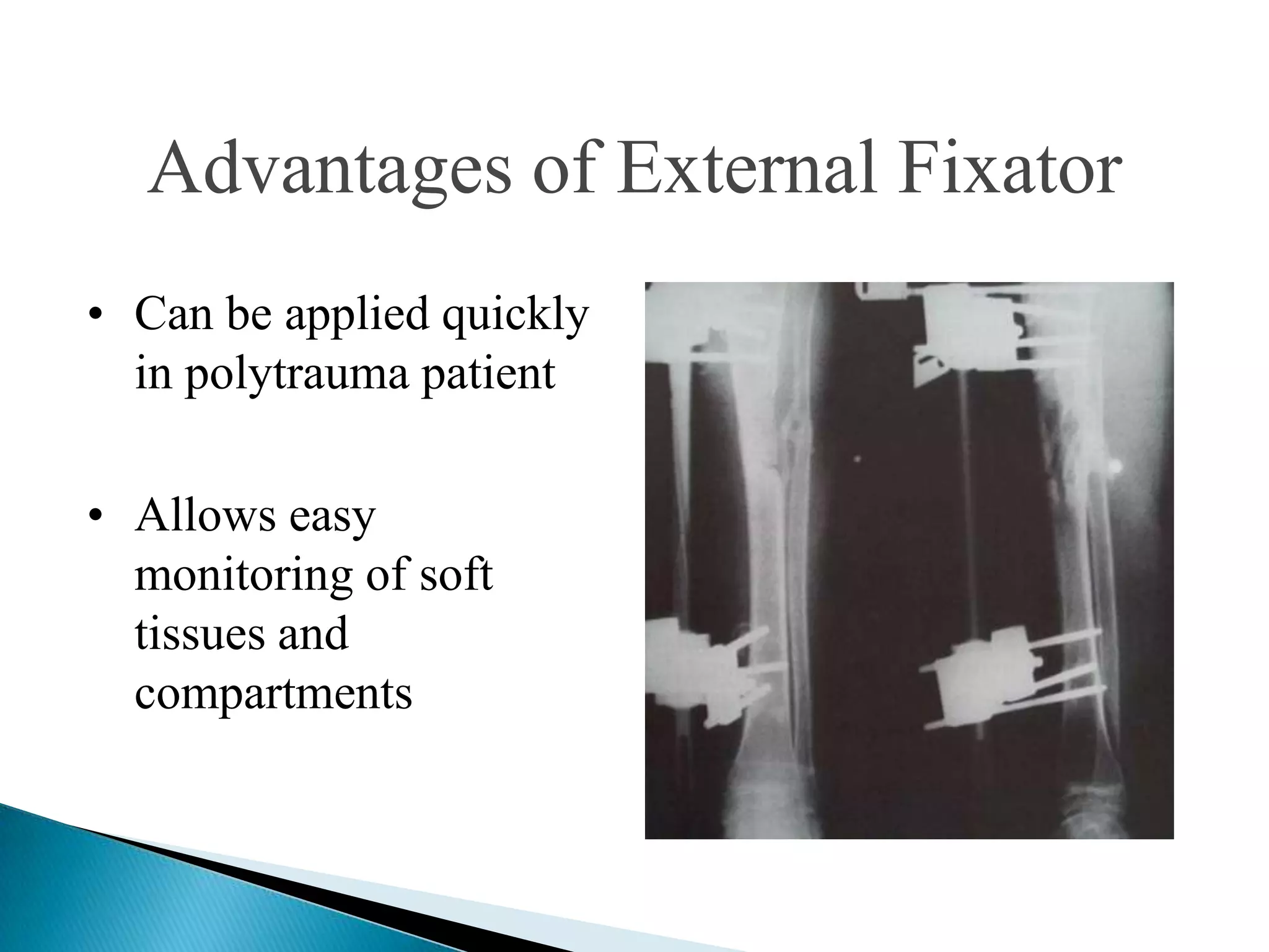 Advantages of External Fixator
• Can be applied quickly
in polytrauma patient
• Allows easy
monitoring of soft
tissues and
compartments

 