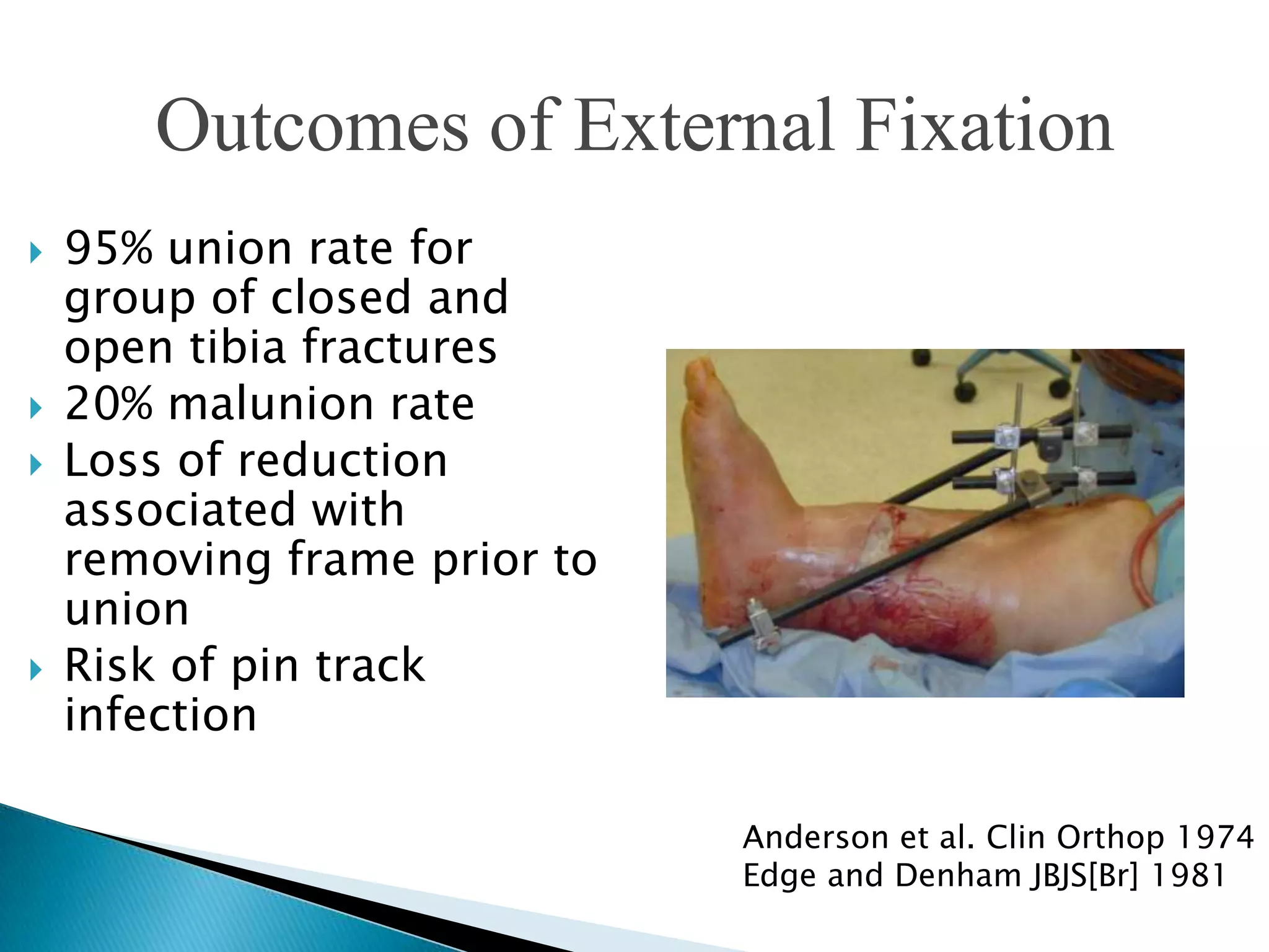 Outcomes of External Fixation







95% union rate for
group of closed and
open tibia fractures
20% malunion rate
Loss of reduction
associated with
removing frame prior to
union
Risk of pin track
infection
Anderson et al. Clin Orthop 1974
Edge and Denham JBJS[Br] 1981

 