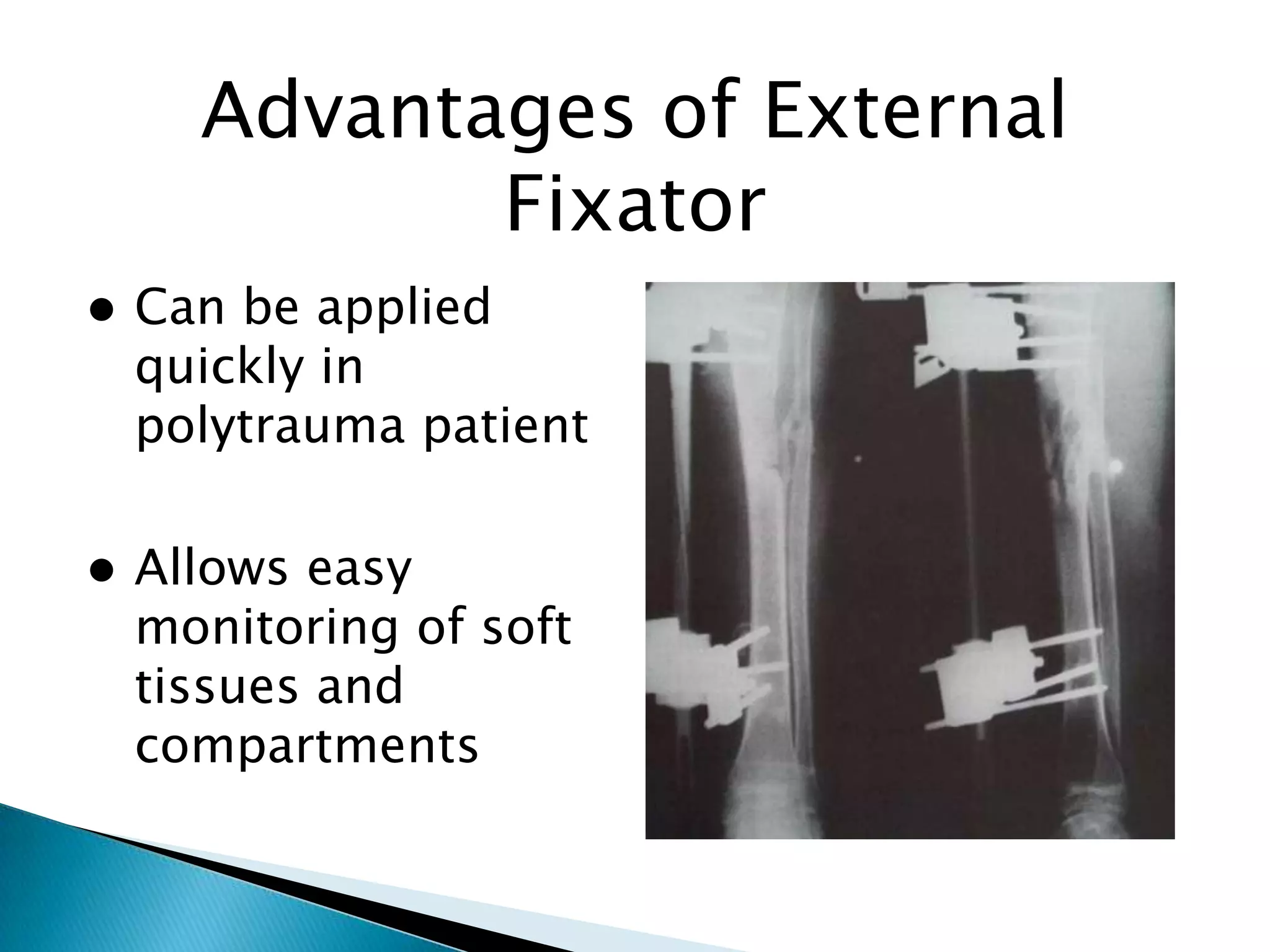 Advantages of External
Fixator


Can be applied
quickly in
polytrauma patient



Allows easy
monitoring of soft
tissues and
compartments

 