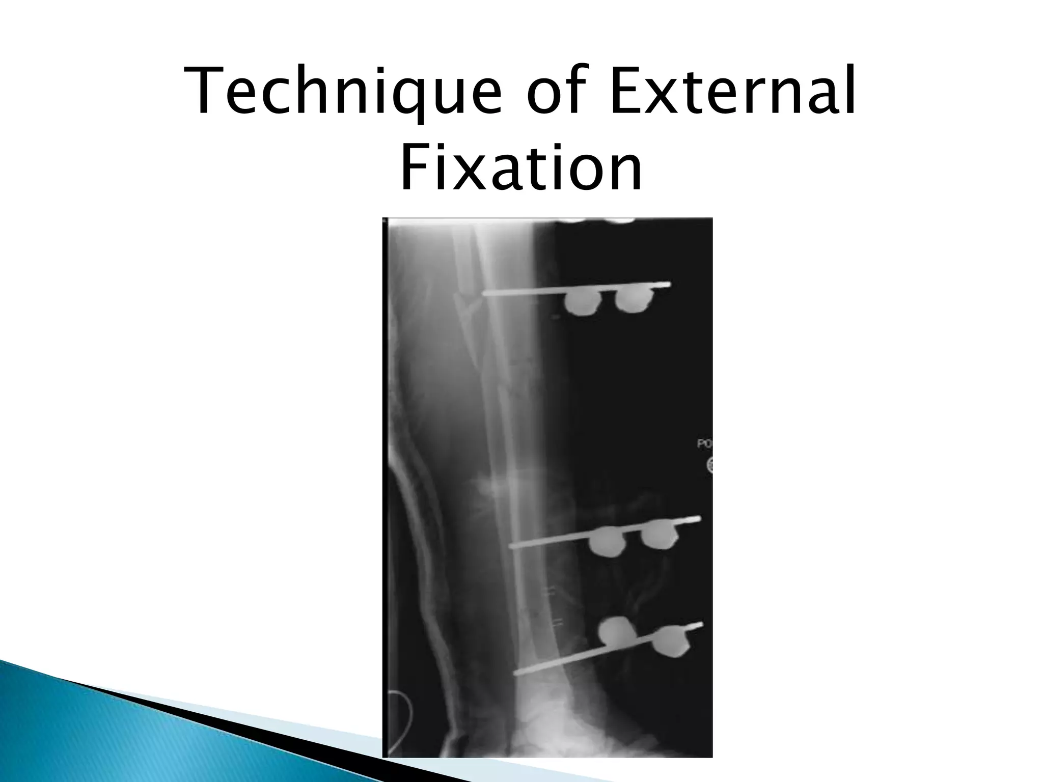 Technique of External
Fixation

 