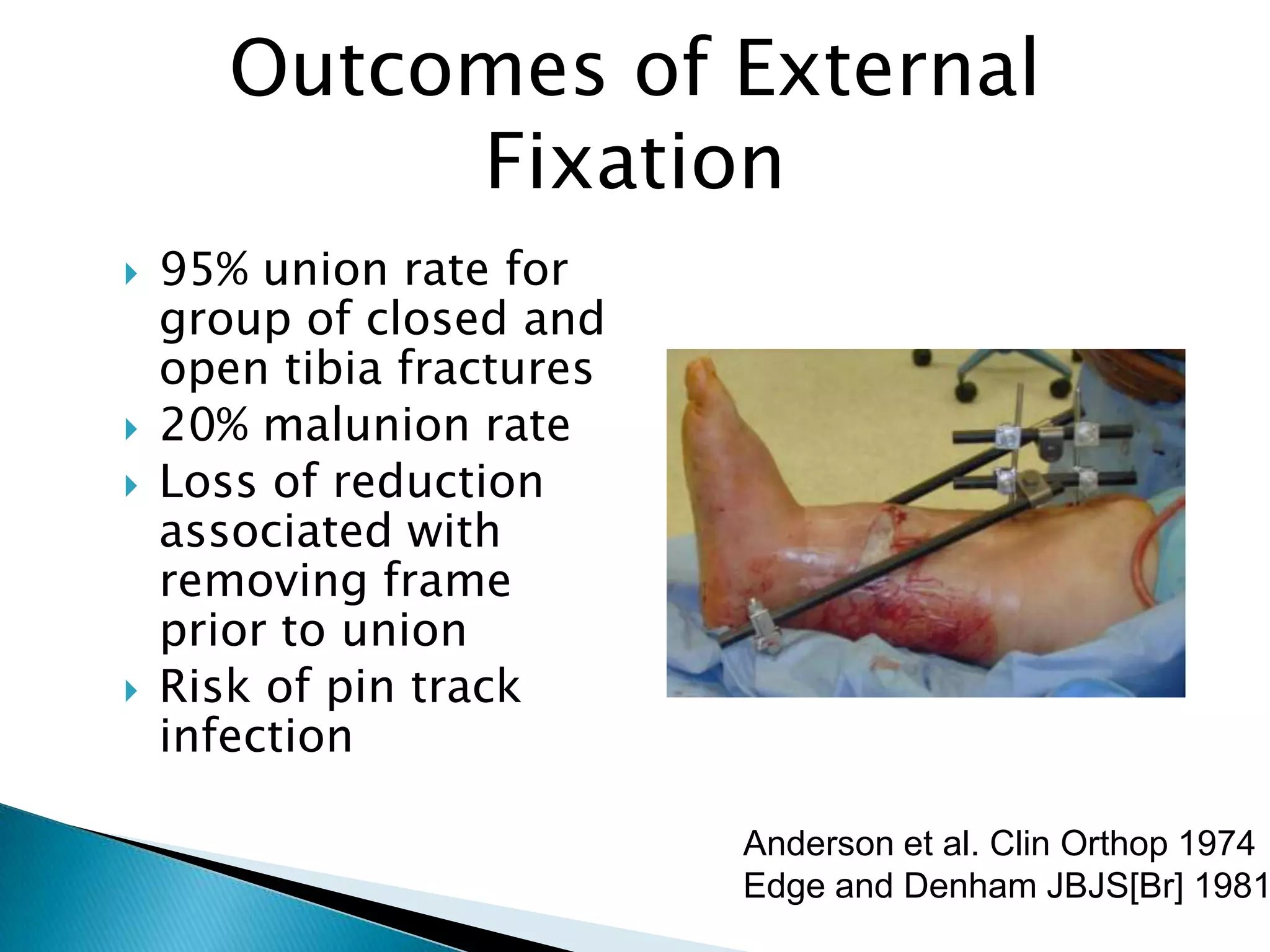 Outcomes of External
Fixation







95% union rate for
group of closed and
open tibia fractures
20% malunion rate
Loss of reduction
associated with
removing frame
prior to union
Risk of pin track
infection

Anderson et al. Clin Orthop 1974
Edge and Denham JBJS[Br] 1981

 