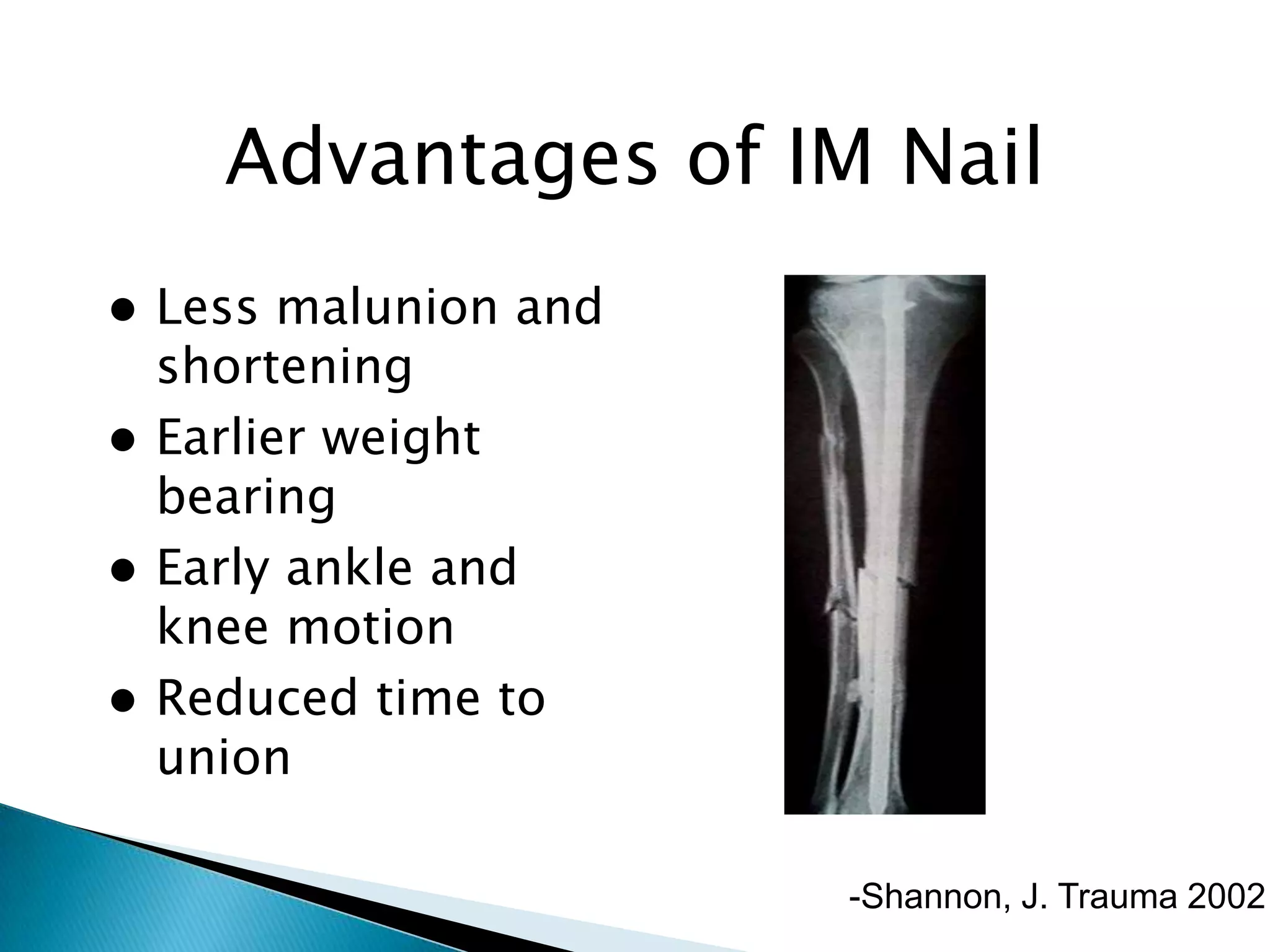 Advantages of IM Nail
Less malunion and
shortening
 Earlier weight
bearing
 Early ankle and
knee motion
 Reduced time to
union


-Shannon, J. Trauma 2002

 