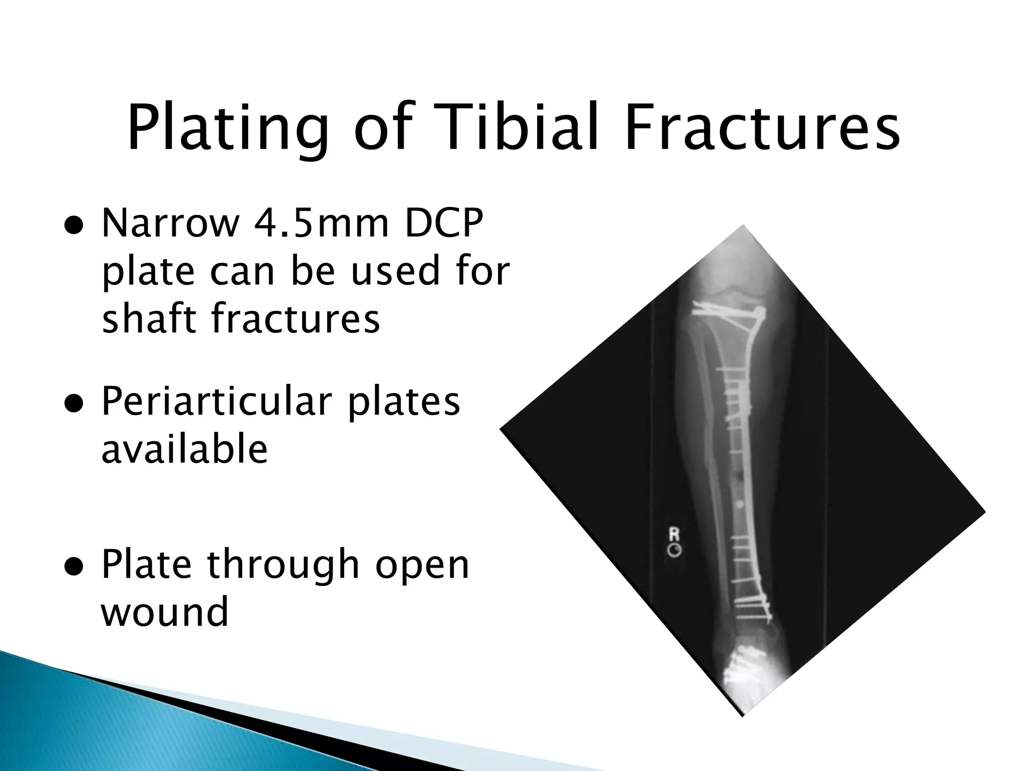 Plating of Tibial Fractures


Narrow 4.5mm DCP
plate can be used for
shaft fractures



Periarticular plates
available



Plate through open
wound

 