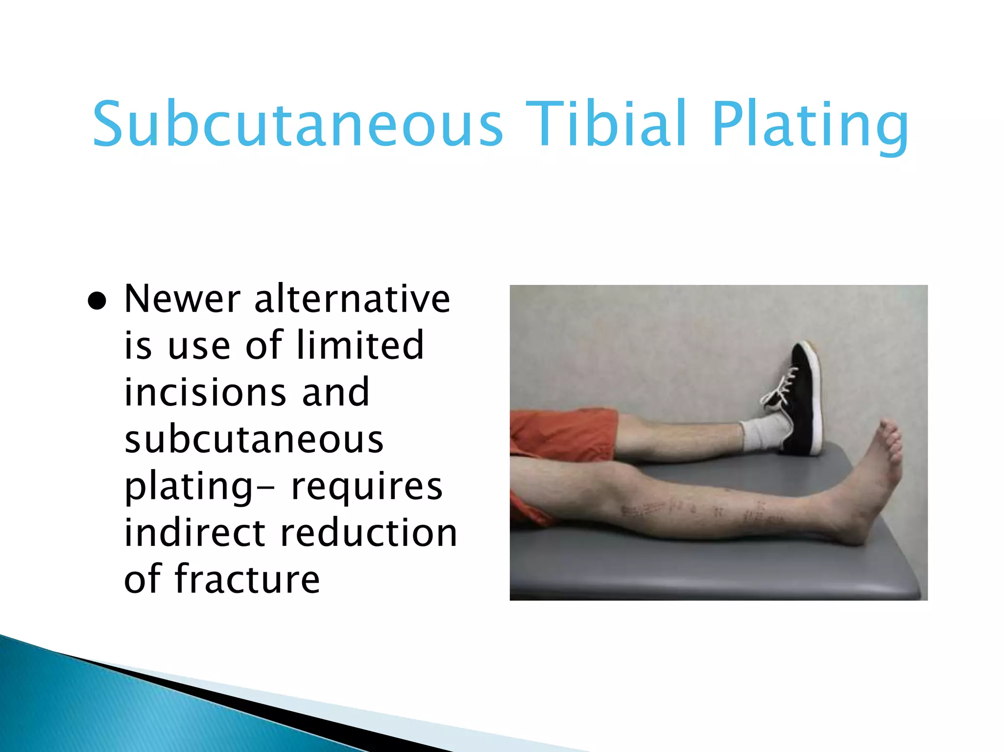 Subcutaneous Tibial Plating


Newer alternative
is use of limited
incisions and
subcutaneous
plating- requires
indirect reduction
of fracture

 