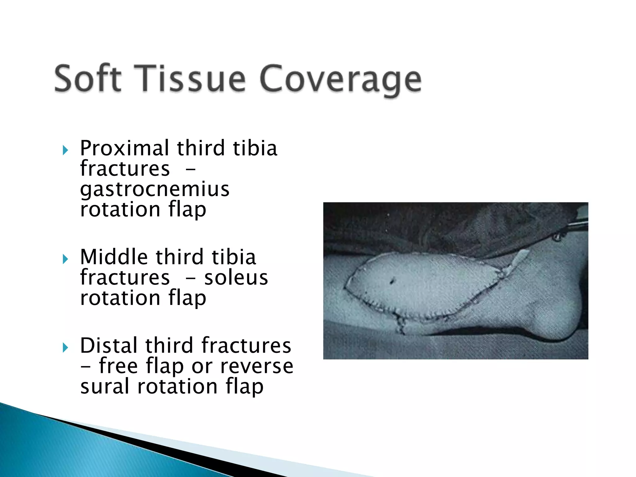 





Proximal third tibia
fractures gastrocnemius
rotation flap
Middle third tibia
fractures - soleus
rotation flap
Distal third fractures
- free flap or reverse
sural rotation flap

 