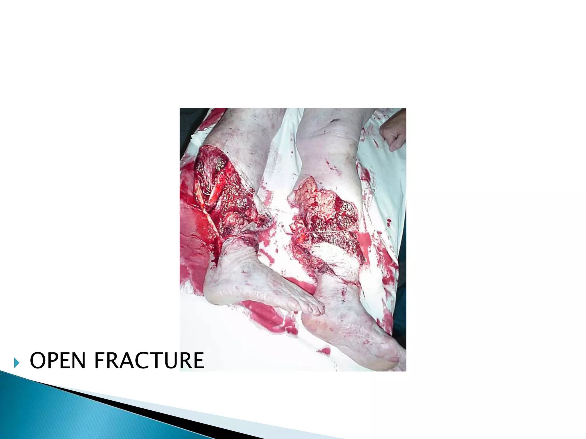 

OPEN FRACTURE

 