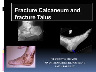 Fracture Calcaneum and
fracture Talus
DR ASHUTOSH KUMAR
AP ORTHOPAEDICS DEPARTMENT
RMCH BAREILLY
 