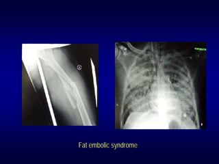 Fat embolic syndrome
 