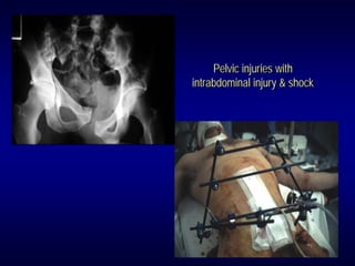 Pelvic injuries with
intrabdominal injury & shock
 