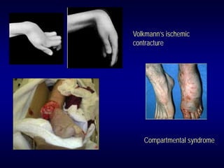 Volkmann’s ischemic
contracture




   Compartmental syndrome
 