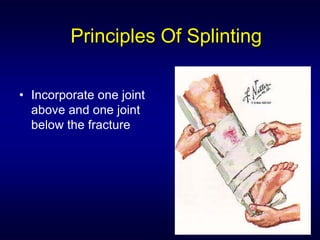 Principles Of Splinting

• Incorporate one joint
  above and one joint
  below the fracture
 