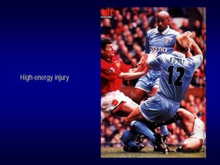 High-energy injury
 