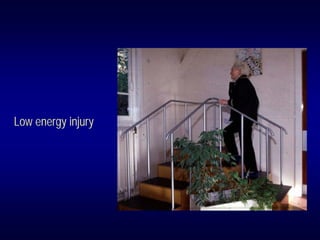 Low energy injury
 