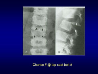 Chance # @ lap seat belt #
 