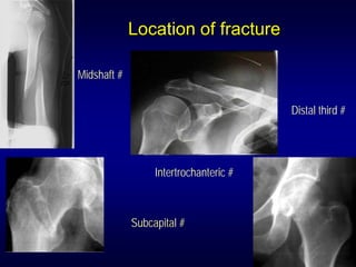 Location of fracture

Midshaft #


                                        Distal third #




                  Intertrochanteric #



             Subcapital #
 