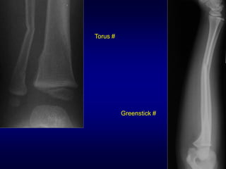 Torus #




          Greenstick #
 