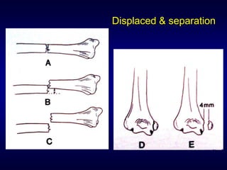 Displaced & separation
 