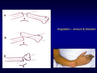 Angulation – amount & direction
 