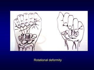 Rotational deformity
 