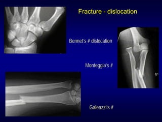 Fracture - dislocation



Bennet’s # dislocation



        Monteggia’s #




          Galeazzi’s #
 