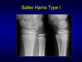 Salter Harris Type I
 