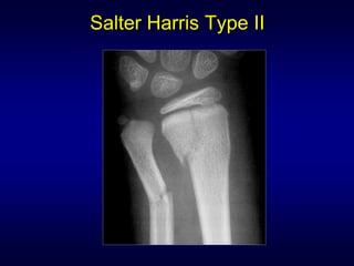 Salter Harris Type II
 