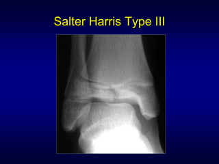 Salter Harris Type III
 