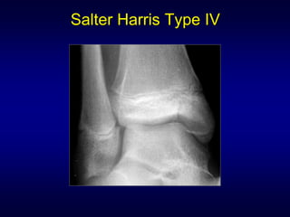 Salter Harris Type IV
 