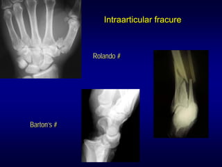Intraarticular fracure



             Rolando #




Barton’s #
 