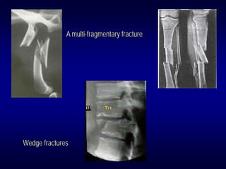 A multi-fragmentary fracture




Wedge fractures
 