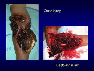Crush injury




        Degloving injury
 