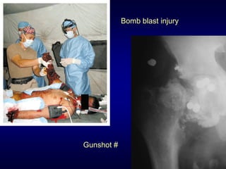 Bomb blast injury




Gunshot #
 