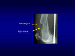 Pathologic #


Lytic lesion
 