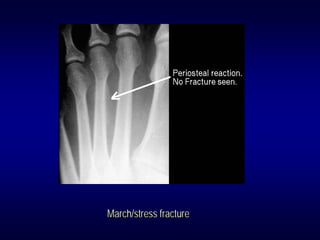 March/stress fracture
 