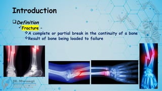 Introduction
Definition
Fracture –
A complete or partial break in the continuity of a bone
Result of bone being loaded to failure
 