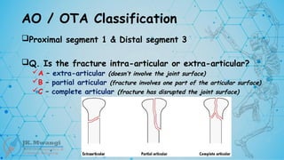 AO / OTA Classification
Proximal segment 1 & Distal segment 3
Q. Is the fracture intra-articular or extra-articular?
A – extra-articular (doesn’t involve the joint surface)
B – partial articular (fracture involves one part of the articular surface)
C – complete articular (fracture has disrupted the joint surface)
 