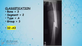 CLASSIFICATION
• Bone = 3
• Segment = 2
• Type = A
• Group = 3
• 32-A3
 