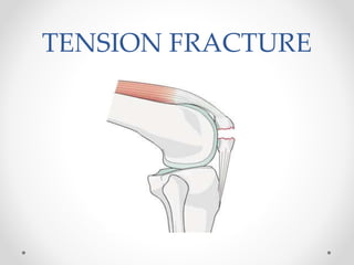TENSION FRACTURE
 