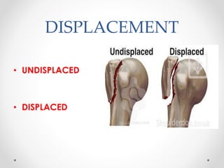 DISPLACEMENT
• UNDISPLACED
• DISPLACED
 