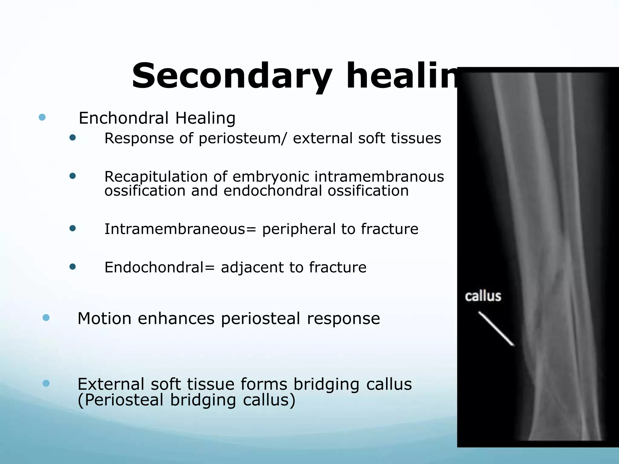 Secondary healing
 Enchondral Healing
 Response of periosteum/ external soft tissues
 Recapitulation of embryonic intramembranous
ossification and endochondral ossification
 Intramembraneous= peripheral to fracture
 Endochondral= adjacent to fracture
 Motion enhances periosteal response
 External soft tissue forms bridging callus
(Periosteal bridging callus)
 