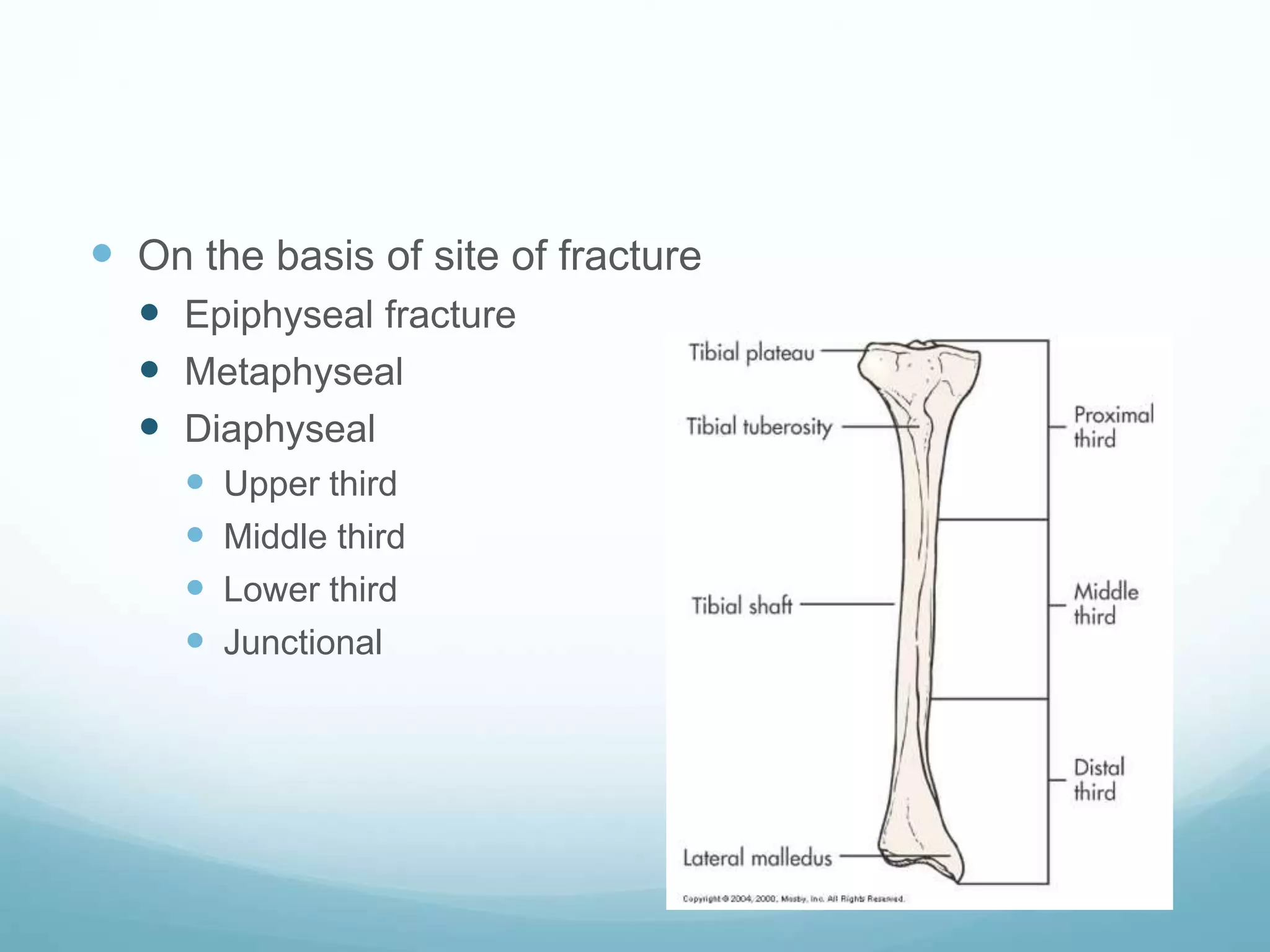 On the basis of site of fracture
 Epiphyseal fracture
 Metaphyseal
 Diaphyseal
 Upper third
 Middle third
 Lower third
 Junctional
 