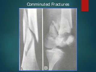 Comminuted Fractures
 