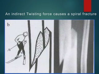 An indirect Twisting force causes a spiral fracture
 