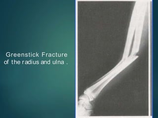 Greenstick Fracture
of the radius and ulna .
 