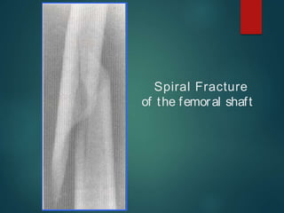 Spiral Fracture
of the femoral shaft
 