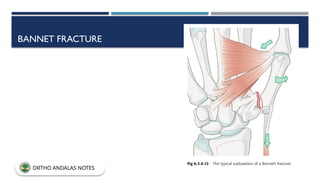 BANNET FRACTURE
ORTHO ANDALAS NOTES
 