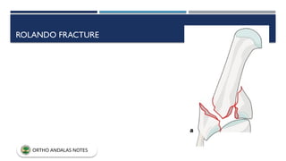 ROLANDO FRACTURE
ORTHO ANDALAS NOTES
 