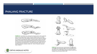 PHALANG FRACTURE
ORTHO ANDALAS NOTES
 