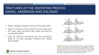 FRACTURES OF THE ODONTOID PROCESS
(DENS) : ANDERSON AND D’ALONZO
 Type I: Oblique avulsion fracture of the apex (5%)
 Type II: Fracture at the junction of the body and
the neck; high nonunion rate, which can lead to
myelopathy (60%)
 Type III: Fracture extending into the cancellous
body of C2 and possibly involving the lateral
facets (30%)
ORTHO ANDALAS NOTES
 
